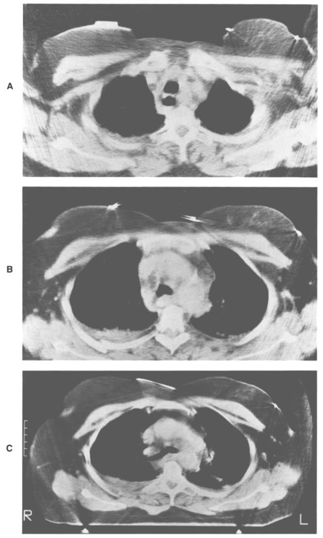 1993 CT for diagnosis of traumatic rupture of the thoracic aorta 133 A B C Fig. 3. Thoracic CT scans of patient 1. Images are degraded by artifacts from ECG leads and from patient motion.