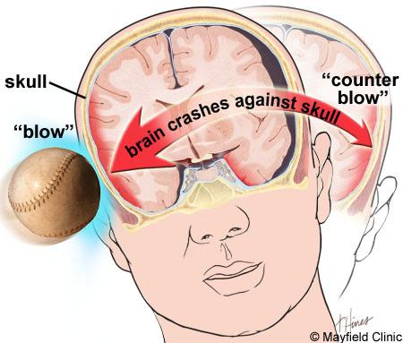 Traumatic Brain Injury (TBI) Overview Traumatic brain injury (TBI) is sudden damage to the brain caused by a blow or jolt to the head.
