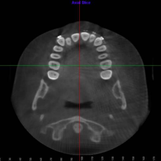 26 Fig. 10. Location of the mid lingual alveolar plates at the maxillary 1 st molars from axial view airway Fig. 11.