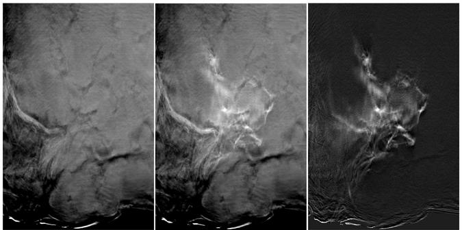 Figure 4B Figure 4. An experiment in contrast-enhanced tomosynthesis was performed using a 52 mm thick mastectomy specimen.
