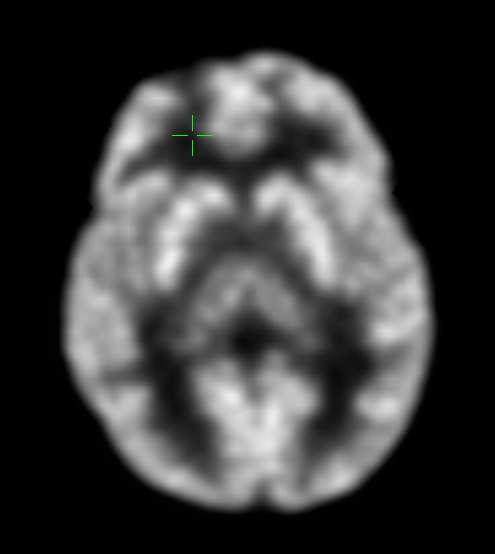 negative MRI Taylor-type focal cortical