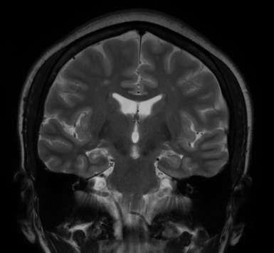 MRI and TLE: Atypical