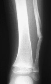 AP radiograph of the left lower leg showing a diaphyseal fracture of the fibula at the age of 4 years. There were no abnormalities in the right lower leg.