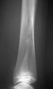 844 K. LELIEFELD, H. VAN DER SLUIJS, I. VAN DER HAVEN Fig. 3. AP radiograph of the left lower leg showing a solid consolidation of the fibular fracture at age 5 years. Fig. 4.