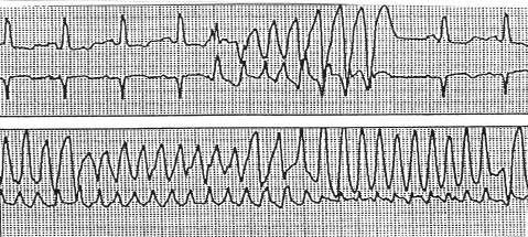 Polymorphic VT with normal QT: Seen frequently in ischemic conditions Think revascularization Think beta blockers 35 Beta Blockers Nonselective: Block both Beta 1 and Beta 2 Propranolol (Inderal)