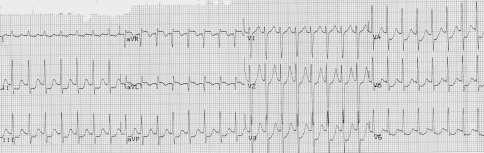 AV Nodal Reentrant Tachycardia (Typical) Most common supraventricular tachycardia Least likely to be life threatening Narrow QRS has no visible P waves