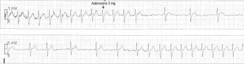 Adenosine to Diagnose 83 Antegrade Conduction over Accessory Pathway Drugs to slow