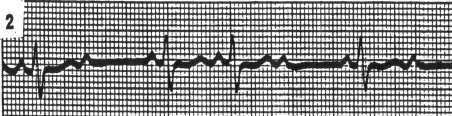 There is a wider than normal QRS problem in the His Perkinje System 91 Inhibits the NA+ and K+ membrane pump