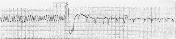 ICD Functions Cardioversion Shock Delivers shocks from 0.1 to 30 joules synchronized on the R wave 2014 www.cardionursing.