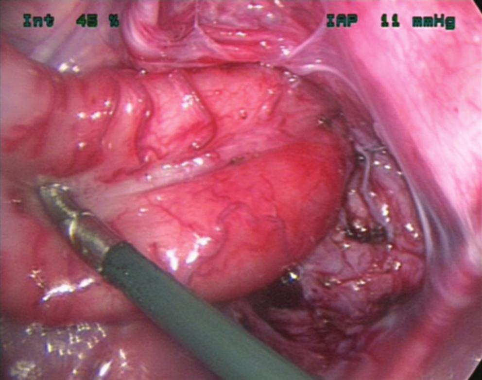 PULL-THROUGH FOR CONGENITAL RECTAL STENOSIS FIG. 5. Pelvic view of colon after completion of the pullthrough. internal and external sphincter, and should have a good prognosis for continence.
