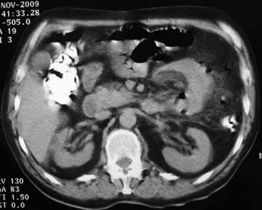 Table 1 Location of small bowel diverticula Meckel 33 Duodenal 19 Jejunum 9 (6 multiple) Ileum 5 (2 multiple) Both 11 Total 77 Figure 1 Computed tomography findings of perforated small bowel