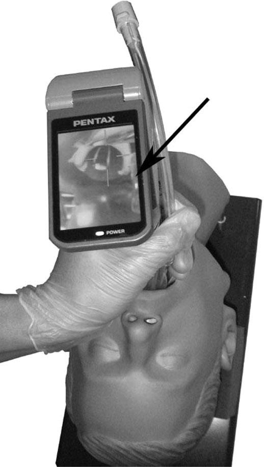 Pentax-AWS (Tokyo, Japan), a video-laryngoscope, consists of a disposable transparent blade (PBLADE w ), a 12 cm cable with a charge-coupled device (CCD) camera, and a 2.4-in.
