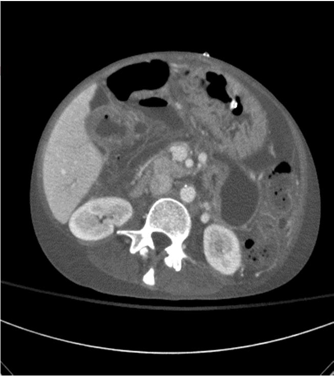Approaches for Abdominal Sepsis 55 yo F with admitted for SBO Hx of XRT & chemorx for SCC of rectum
