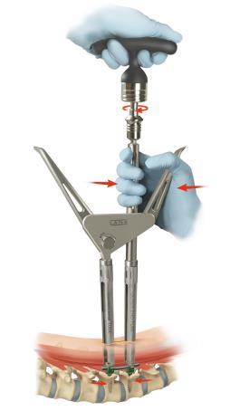 Note: Verify using fluoroscopy that the rod remains contained within the screw head.