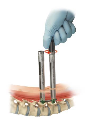 INNER/OUTER TUBE REMOVAL Confirm construct assembly and pedicle screw placement with fluoroscopy