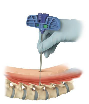TARGETING NEEDLE AND GUIDE WIRE PLACEMENT Using fluoroscopy, insert the targeting needle to the level of the pedicle through