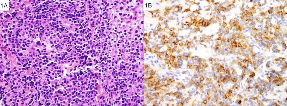 Recently, loss of BAP1 expression was reported in 19 basal cell carcinomas (BCC) from 4 patients in 2 families with BAP1 germline mutations (Clin Genet 2014 Jul 31).