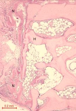 New bone (N) can be seen spanning across the defect and growing