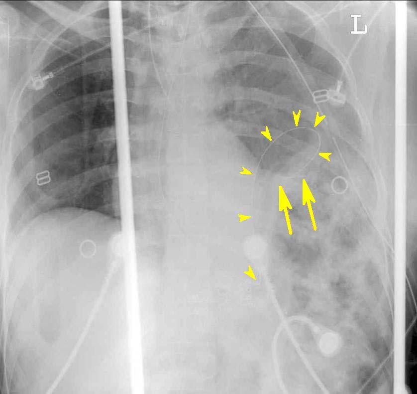 Menu of Tests: Plain Chest Film, differential diagnosis for NG tube seen in left thorax Differential diagnosis for NG tube tip overlying the chest on plain film: 1) Tip is still inside the stomach