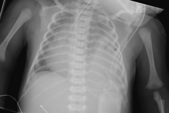 Supine plain film of the chest; Bochdalek hernia Differentiate from TDR by absence of