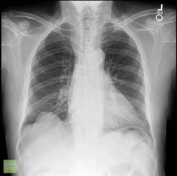 Diaphragmatic Fake-out 2: Diaphragmatic Eventration Congenital absence of functional diaphragmatic musculature with incomplete muscularization of the diaphragm and a thin membranous sheet replacing a