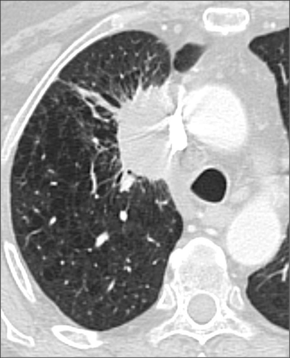 Fig. 6: Figure 1. Chest CT scan shows a spiculated left upper lobe nodule measuring 2.2 x 2.