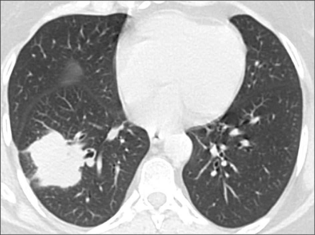 Fig. 7: Figure 2. Chest CT scan shows a spiculated paramediastinal mass in the right upper lobe measuring 4.5 x 3.