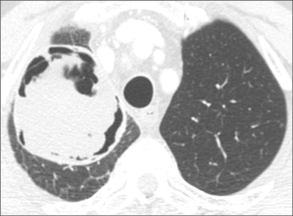 Fig. 9: Figure 4. Chest CT scan shows a large cavitated mass in the right upper lobe measuring 8 x 8.5 x 7.6 cm.