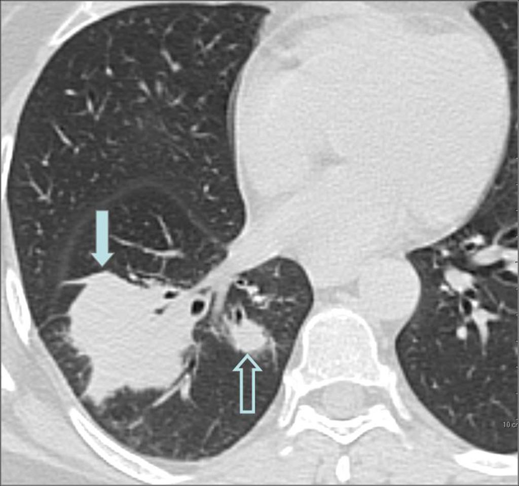 Fig. 10: Figure 5. Chest CT scan shows a lobulated mass in the right lower lobe measuring 5.2 cm (solid arrow).