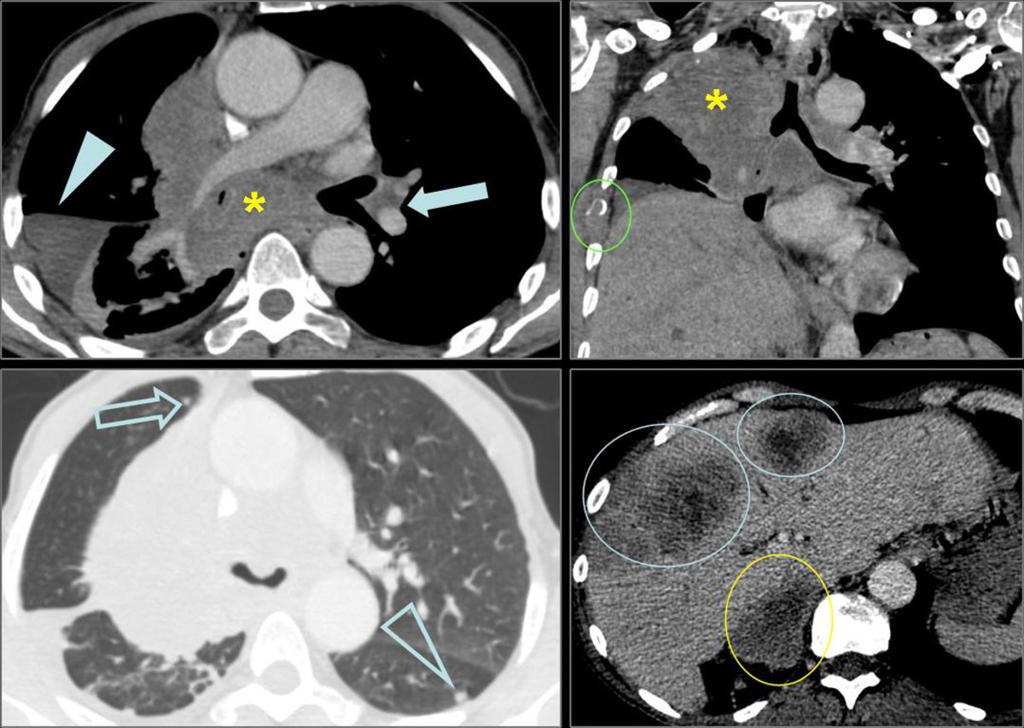 Fig. 11: Figure 6. Right hilar mass (*) presenting with massive mediastinal invasion (trachea, carina, aortic arch, esophagus).