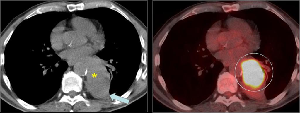 Images for this section: Fig. 1: Figure 7. NSCLC (adenocarcinoma) in a 55 year-old (yo) male.
