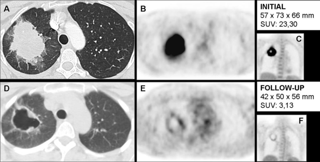 The presence of atelectasis limits the visualization of the true limits of the tumor. Axial PET/CT image of the chest is of great help in the differentiation of the mass from obstructive atelectasis.
