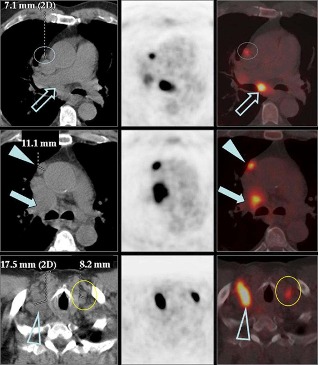 Fig. 4: Figure 10. Right hilar adenocarcinoma in a 60-yo patient (same patient as in Figure 7). The patient underwent PET-CT after diagnostic CT.