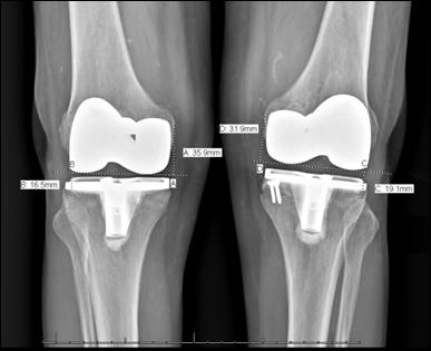 both lateral and anteroposterior views x-rays post-surgery.