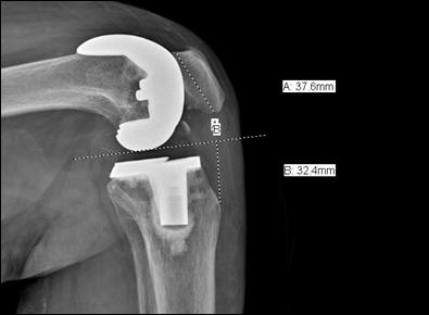 cases where medial epicondyle to joint line distance and 3 cases where fibula head to joint line distance could not be measured on the anteroposterior x-rays.