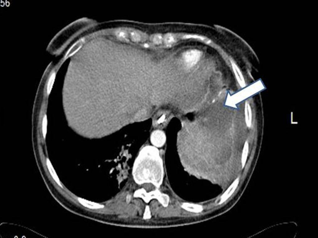 Fig. 6: Common site of abscess.