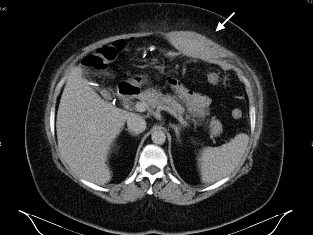 Fig. 7: Abdominal wall hematoma.