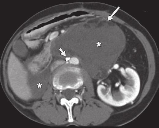 Bestic et al. A C Fig. 1 62-year-old woman with recurrent retroperitoneal sclerosing variant of well-differentiated liposarcoma mimicking more aggressive liposarcoma.