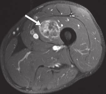 Scattered strands of nonlipomatous tissue with attenuation values similar to skeletal muscle are distributed throughout mass (arrow). B, Axial T1-weighted MR image (TR/TE, 800/9.