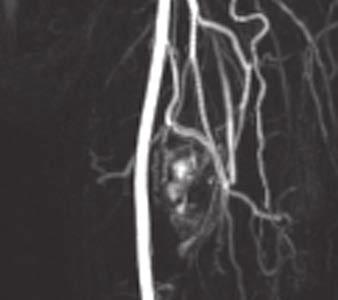 E, Coronal maximum-intensity-projection MR angiogram (TR/TE, 3.59/1.17) through mid thigh shows multiple arterial vessels directly supplying mass with globular enhancement of nonlipomatous tissues.
