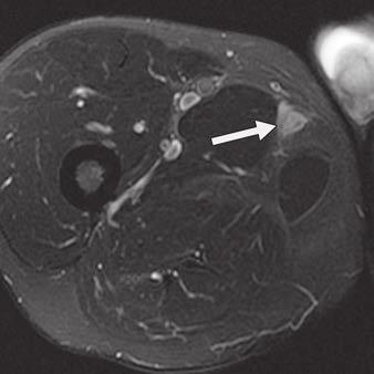 homogeneous high signal intensity typical of the myxoid subtype of liposarcoma.