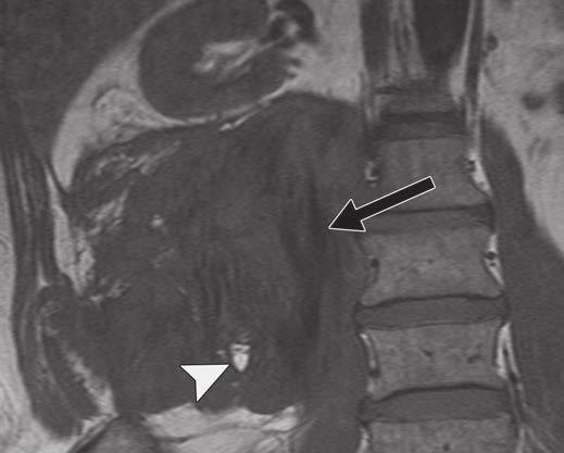 Additional well-circumscribed mass (arrow) of similar attenuation is situated in mesentery.