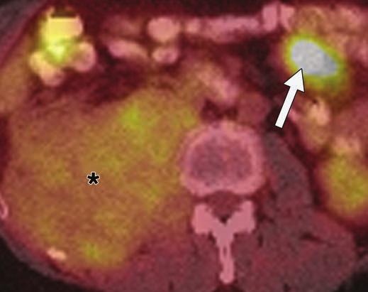 Biopsy of large retroperitoneal mass revealed sclerosing histologic features with evidence of low-grade dedifferentiation.