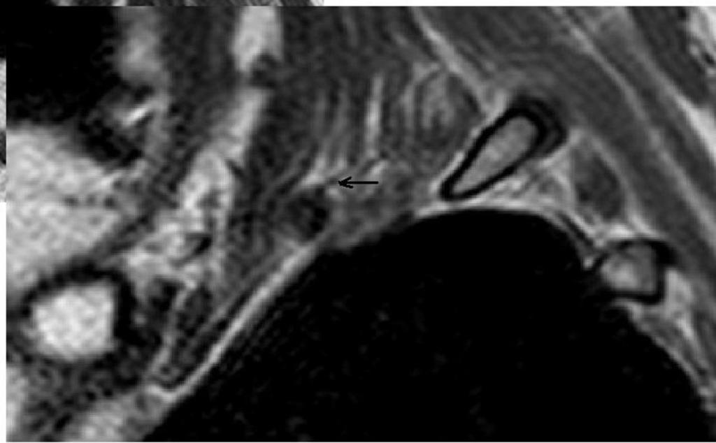 Fig. 2: Sagittal T1W MRI shows on the left side hypertrophy of the transverse process of the C7 (demonstrated