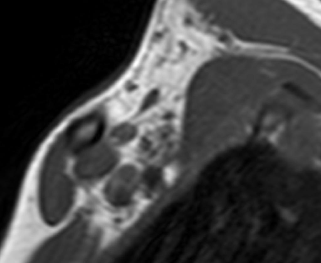 Fig. 3: Sagittal T1W MRI shows change in the subclavian artery calibre in hyperabduction, caused by a fibrous