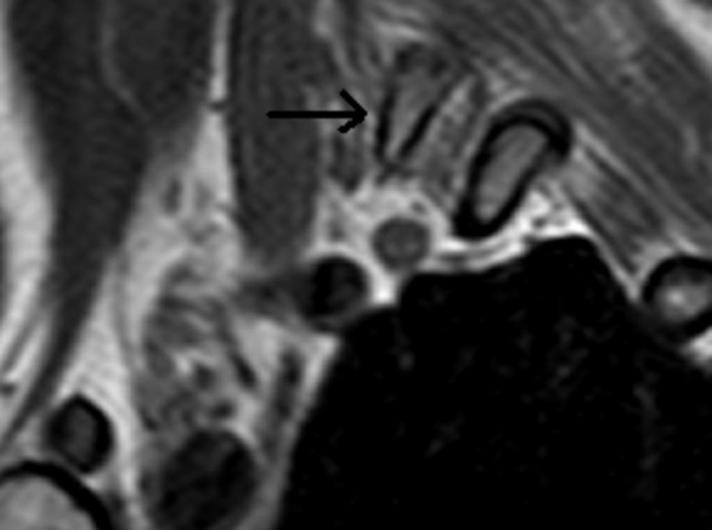 Fig. 6: Sagittal T1W MRI shows a