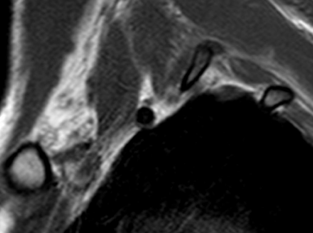 Fig. 11: Sagittal T1W MRI in the neutral position, shows slight abolition of the fat anteriorly