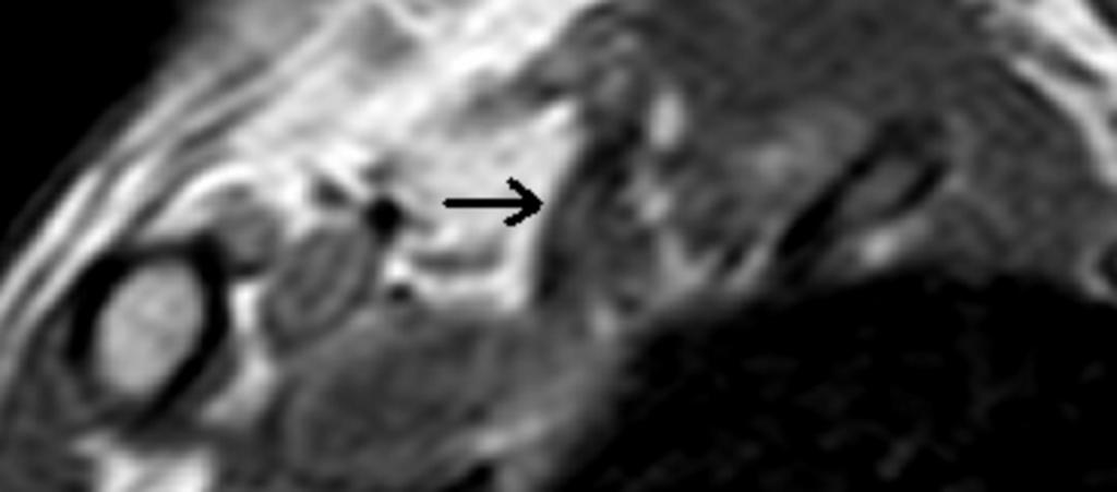 Fig. 13: Sagittal T1W MRI in the neutral position, shows slight abnormal arterial calibre within the scalene triangle and a fibrous