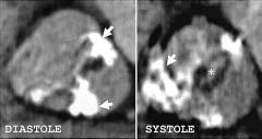 J Heart Valve Dis Aortic valve calcification and AS 497 Figure 4: Severe aortic valve calcification. A 67-year-old male with severe valve calcification (AVC score 10,107.