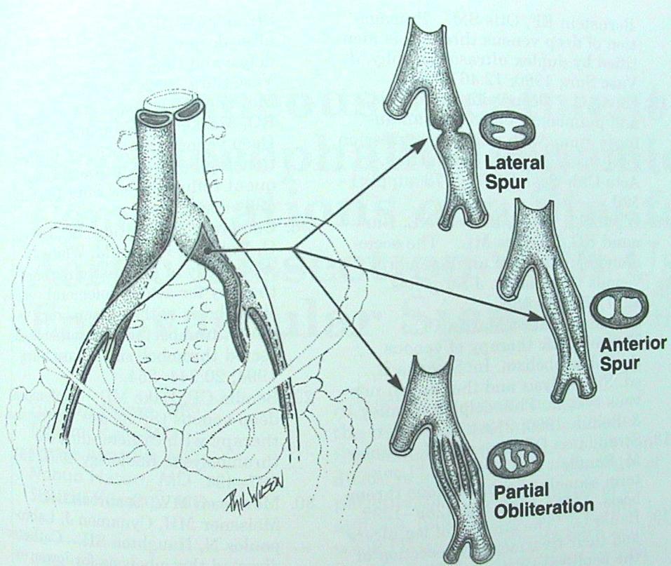 LCIV compressed between RCIA/spine